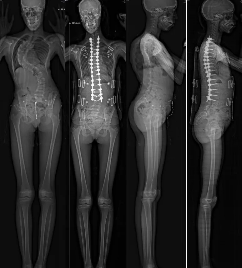 Before-and-after spinal radiographs from a specific scoliosis case supplied by Xinhua Hospital; not a general outcome prediction